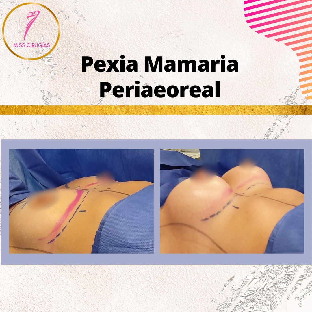 mamoplastia-pexia-mastopexia-misscirugias