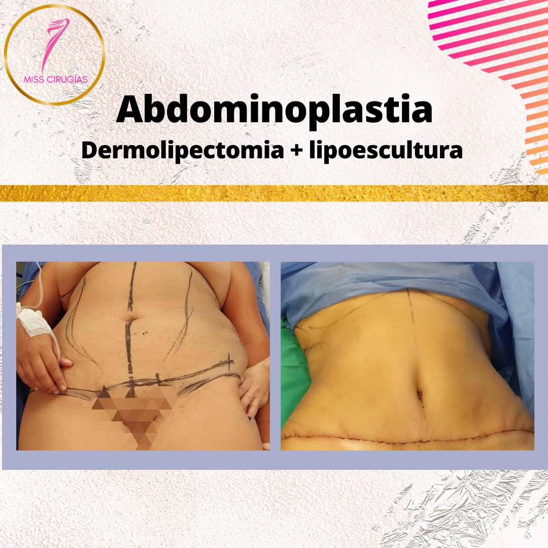 liposuccion-lipoescultura-dermolipectomia