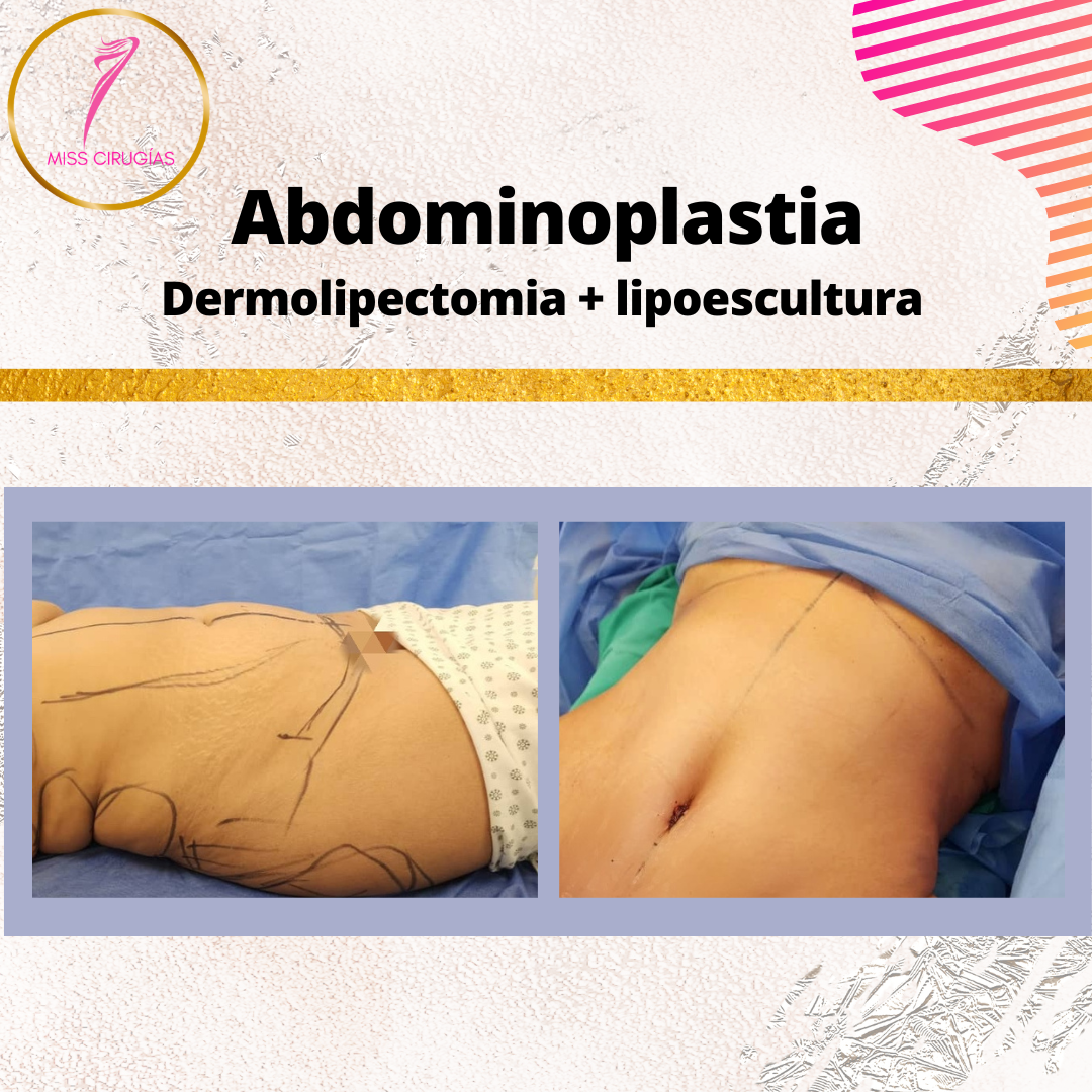 liposuccion-lipoescultura-dermolipectomia