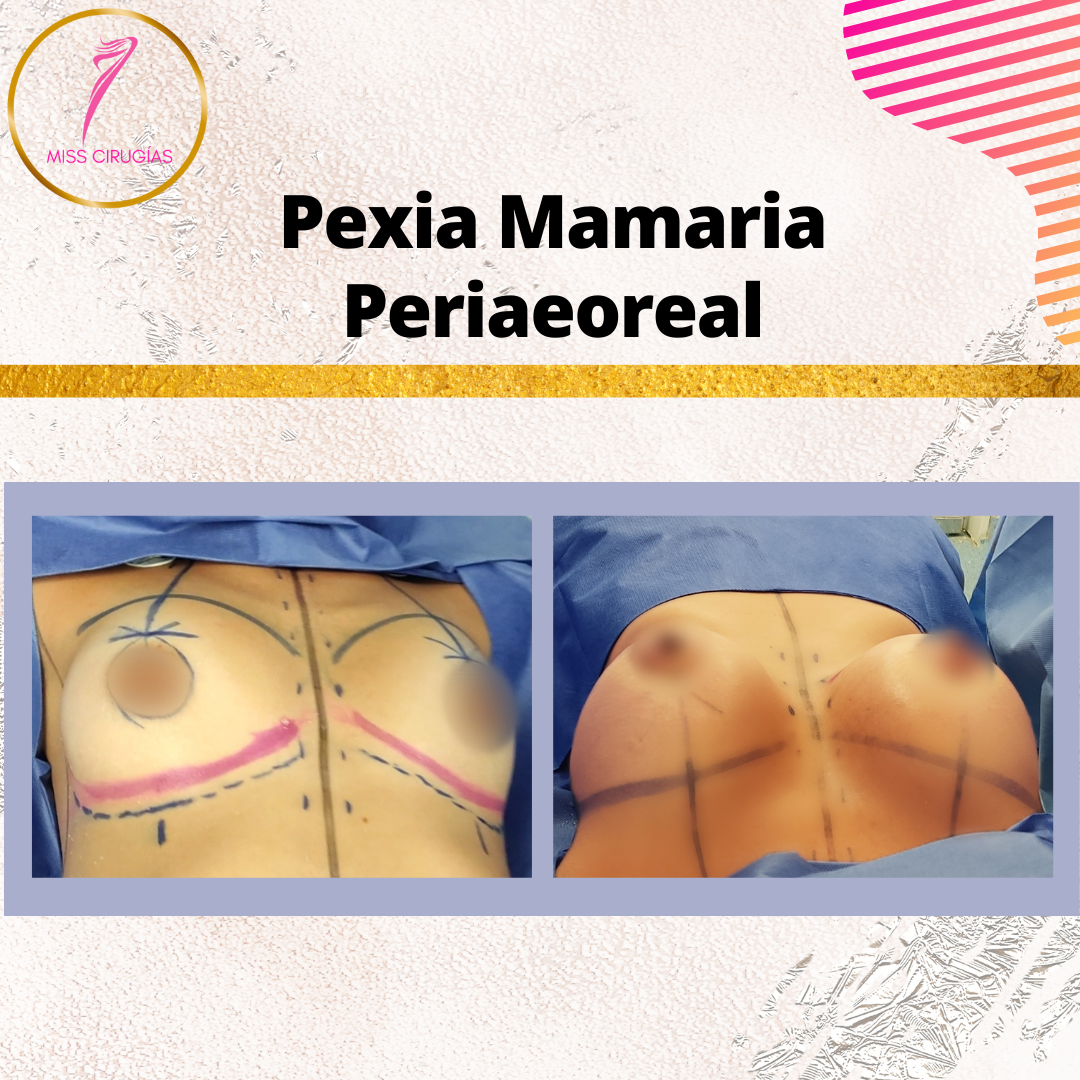 mamoplastia-pexia-mastopexia-misscirugias