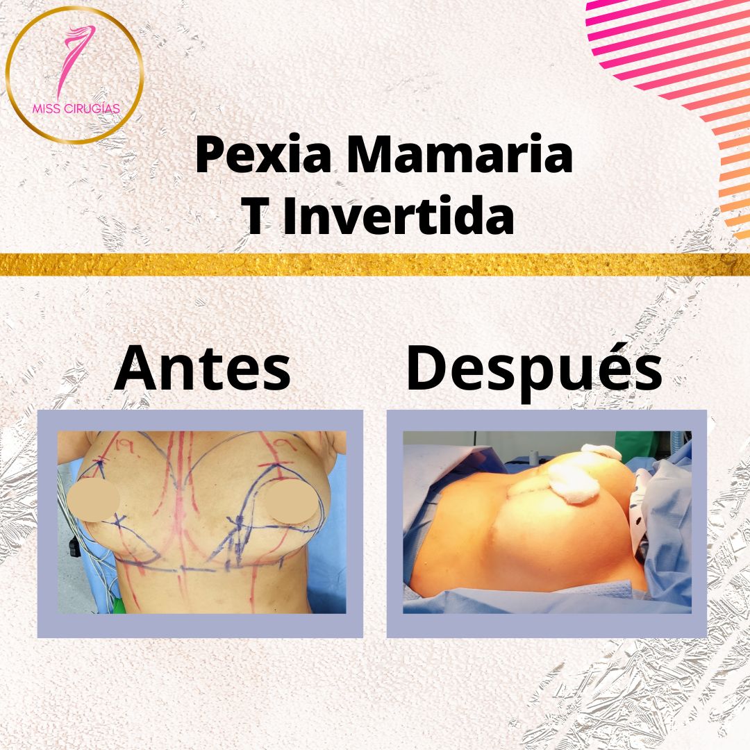 pexia-mamaria-misscirugias