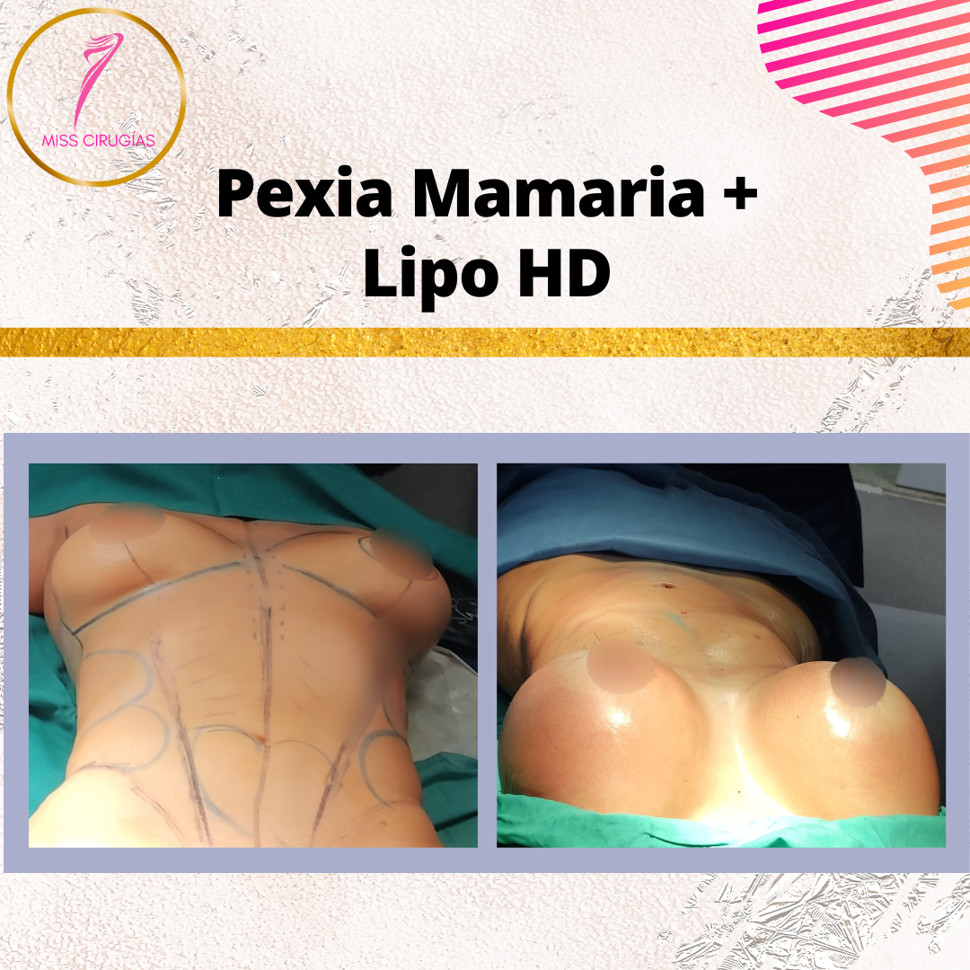 mamoplastia-pexia-mastopexia-misscirugias-lipohd