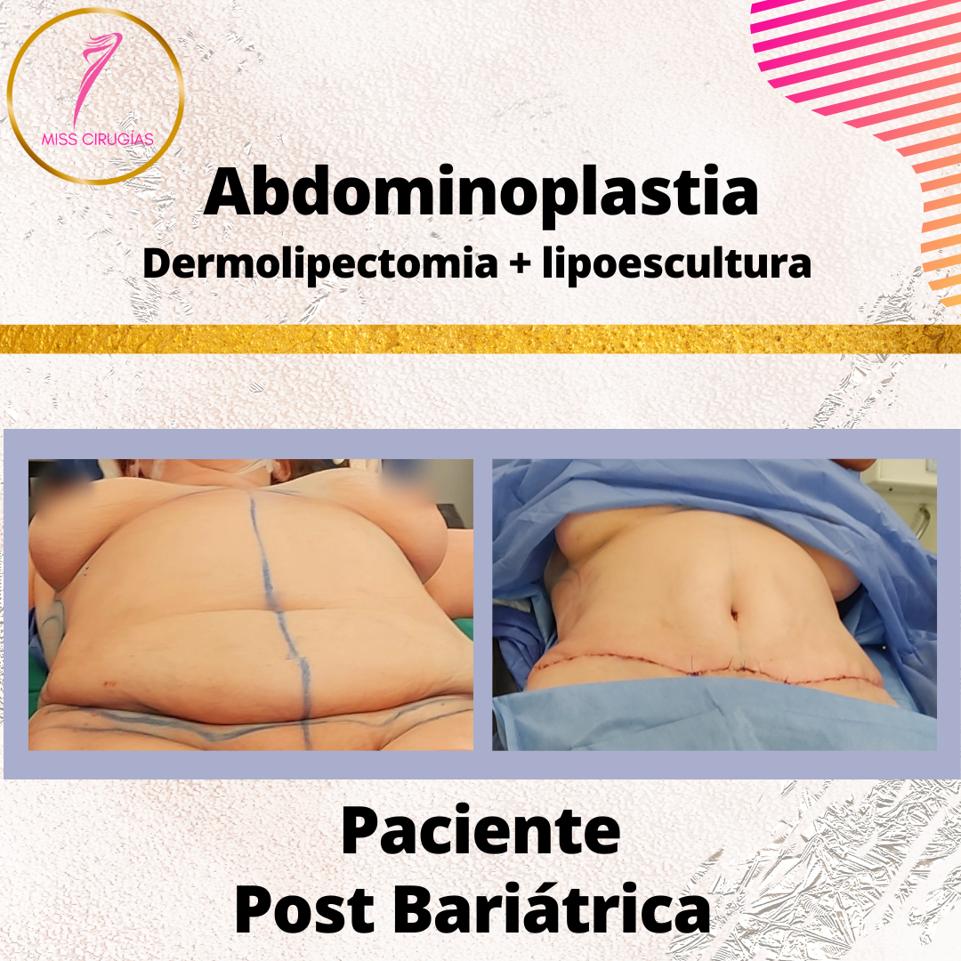 liposuccion-lipoescultura-dermolipectomia-bariatrica
