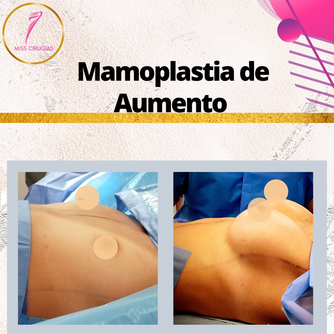 mamoplastia-pexia-mastopexia-misscirugias