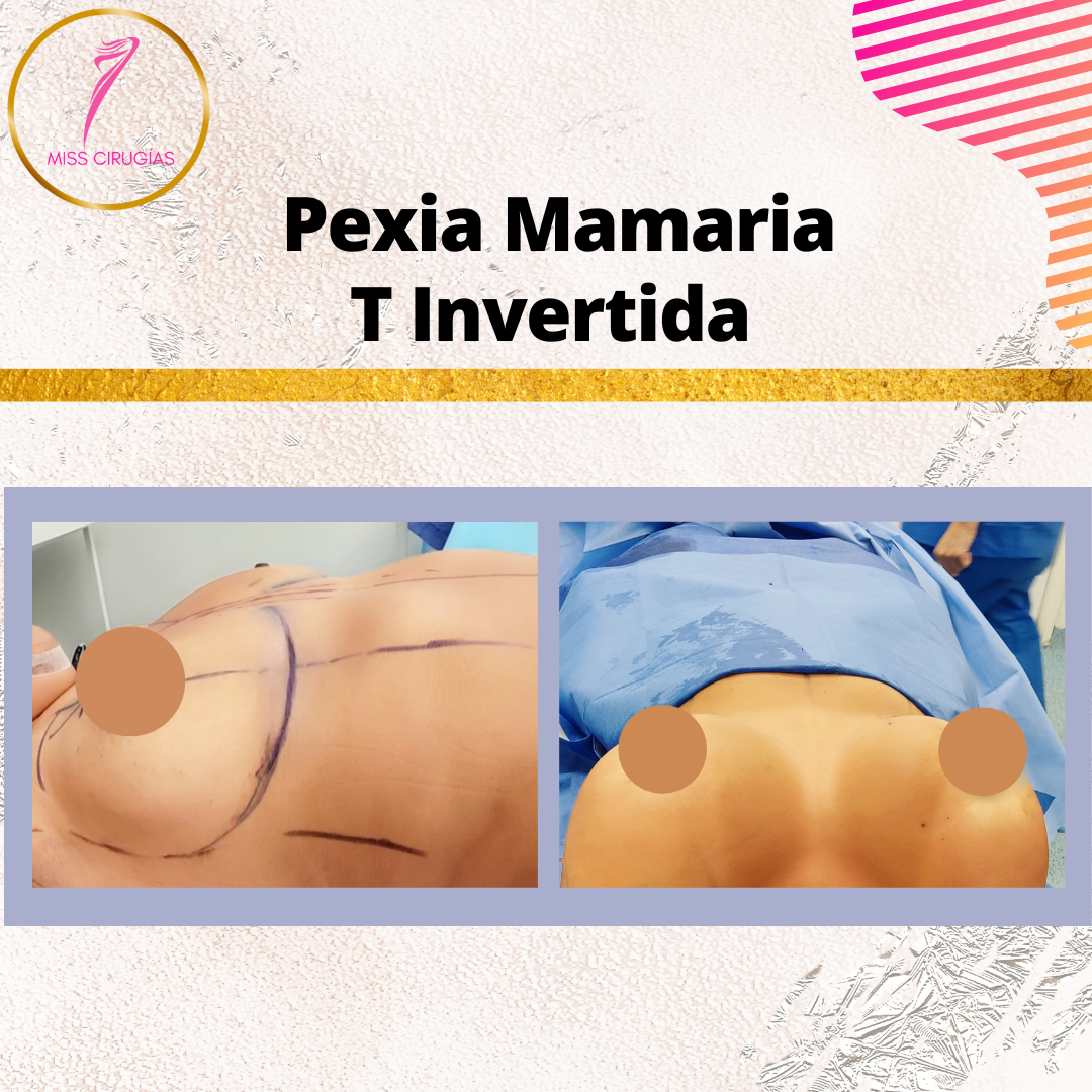 pexia-mamaria-misscirugias
