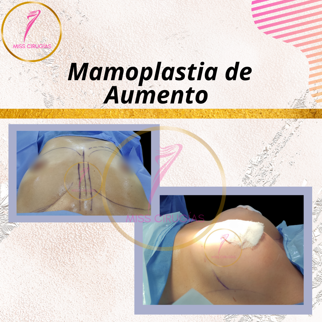 mamoplastia-de-aumento