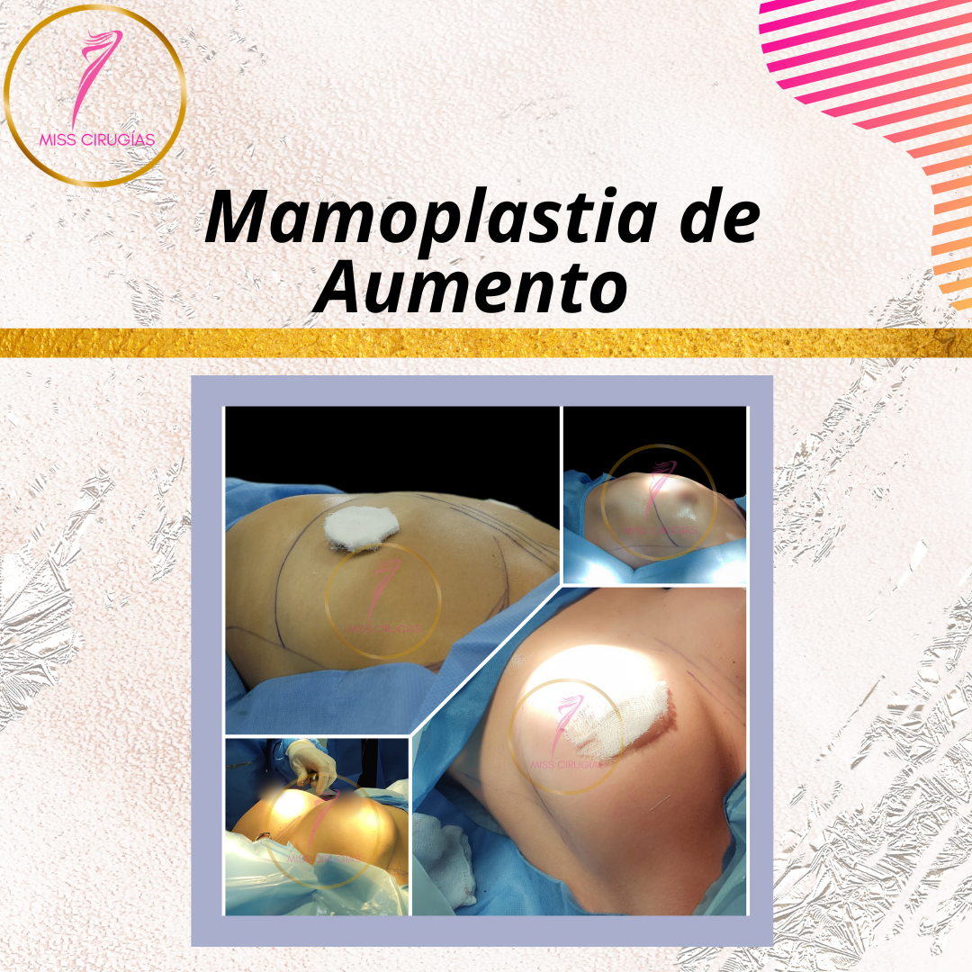 mamoplastia-de-aumento